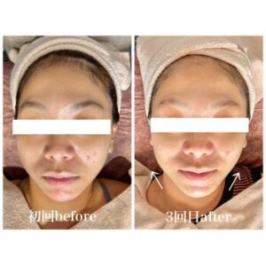 神戸/エステ/肌質改善